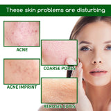 Acne Clear Serum